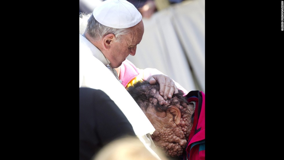 Pope Francis embraced Vinicio Riva, a disfigured man who suffers from a non-infectious genetic disease, during a public audience at the Vatican in November 2013. Riva then buried his head in the Pope's chest.